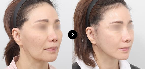 Full SMAS Face Lifting image 6