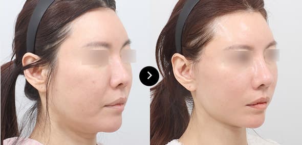 Semi Facelift image 1