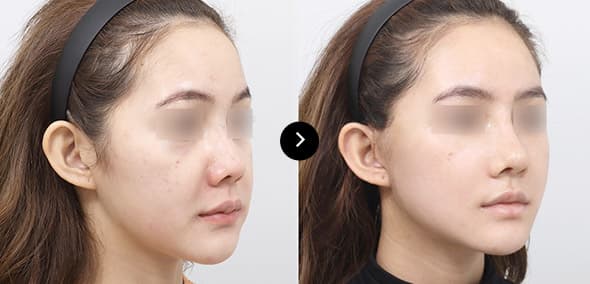 Semi Facelift image 3