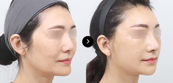 Semi Facelift image 4