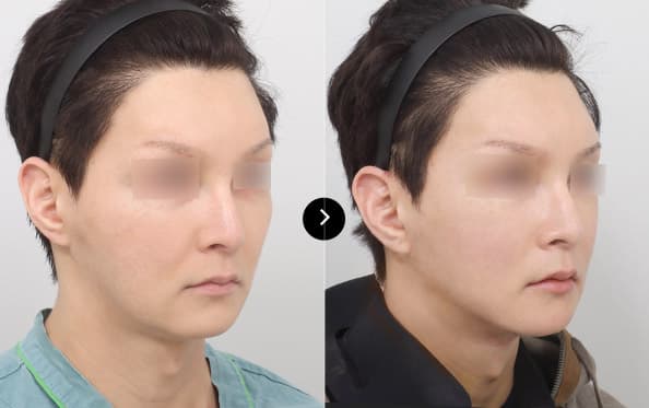 Mini Facelift image 1