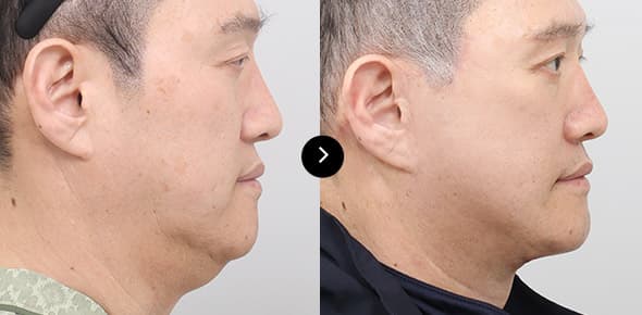 ยกกระชับคอ image 1