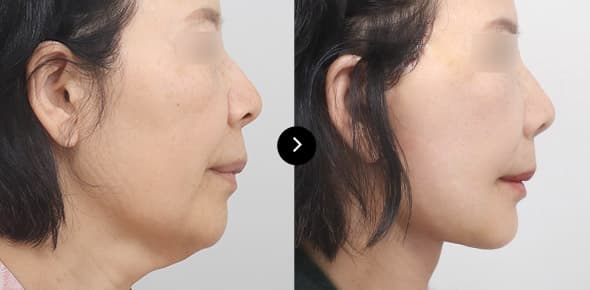 ยกกระชับคอ image 2