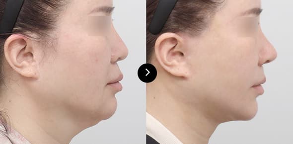 ยกกระชับคอ image 3