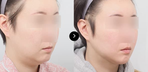 ยกกระชับกรอบหน้าโดยไหม Elasticum image 2