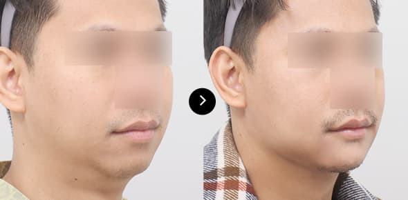 ยกกระชับกรอบหน้าโดยไหม Elasticum image 3