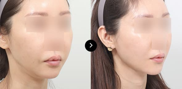 ยกกระชับกรอบหน้าโดยไหม Elasticum image 4