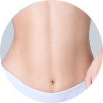 Liposuction result 3