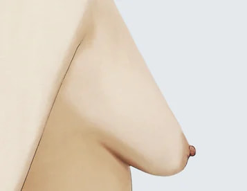 ภาวะหน้าอกหย่อนคล้อยเทียม