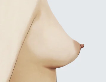 รูปทรงหน้าอกลักษณะพิเศษอื่น ๆ