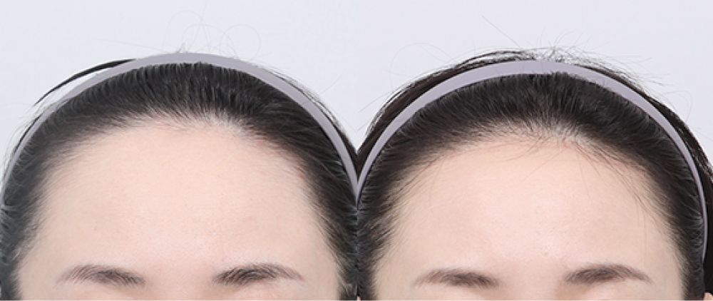 Clear Effect Through Scalp Advancement