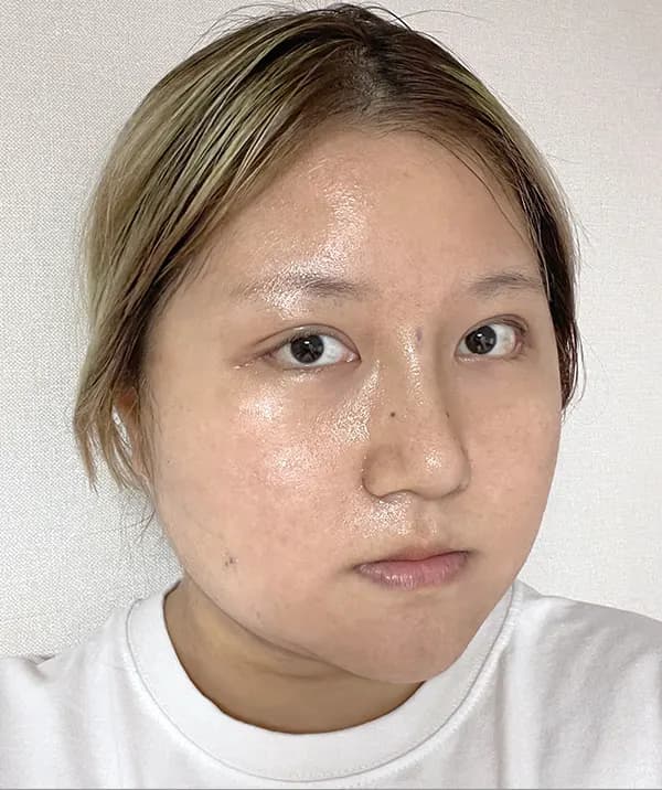 หลังผ่าตัด 7 วัน