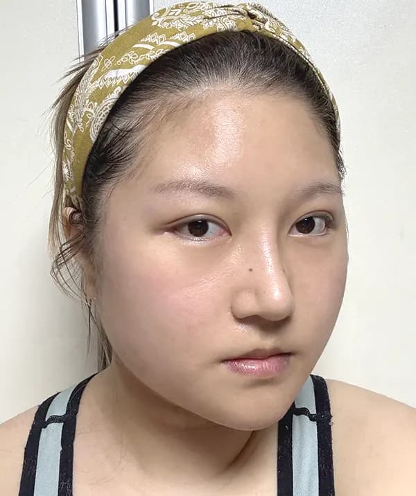 หลังผ่าตัด 14 วัน