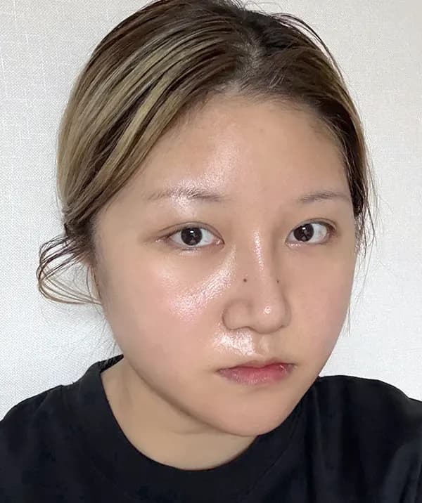 หลังผ่าตัด 21 วัน