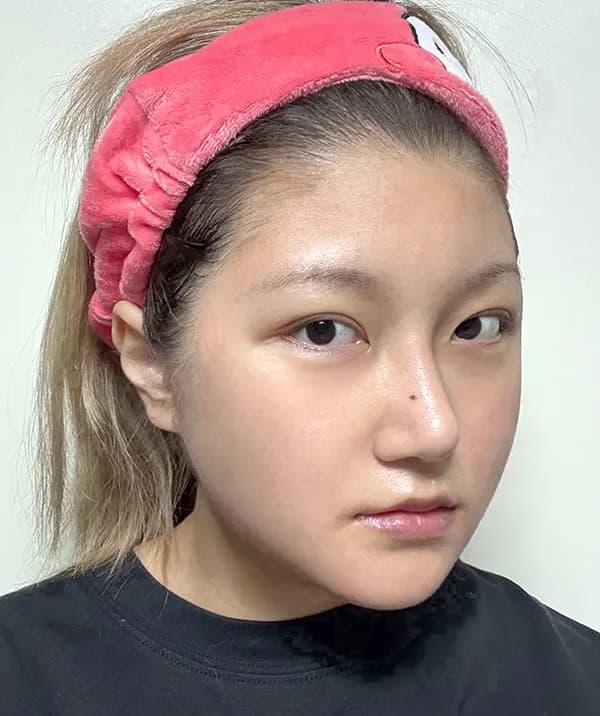 หลังผ่าตัด 30 วัน
