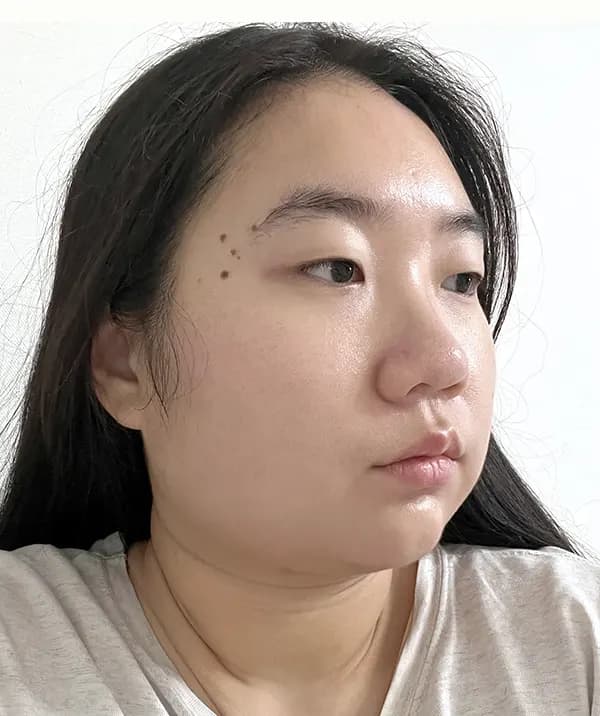 ก่อนผ่าตัด