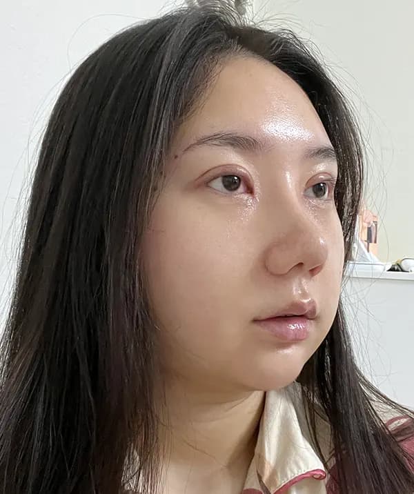 หลังผ่าตัด 14 วัน