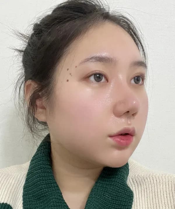 หลังผ่าตัด 30 วัน