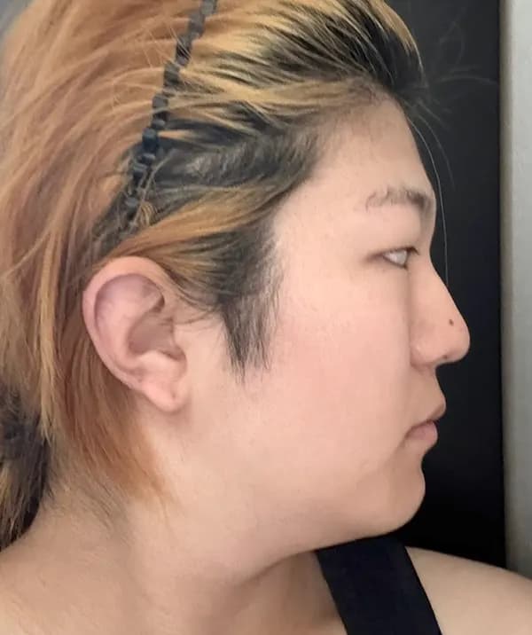 ก่อนผ่าตัด