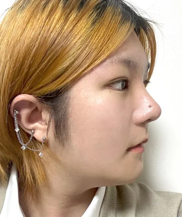 หลังผ่าตัด 14 วัน