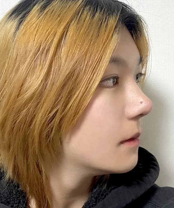 หลังผ่าตัด 30 วัน