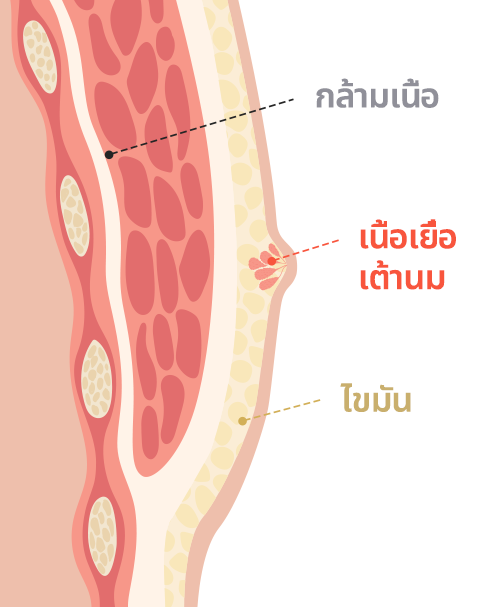 Gynecomastia surgery