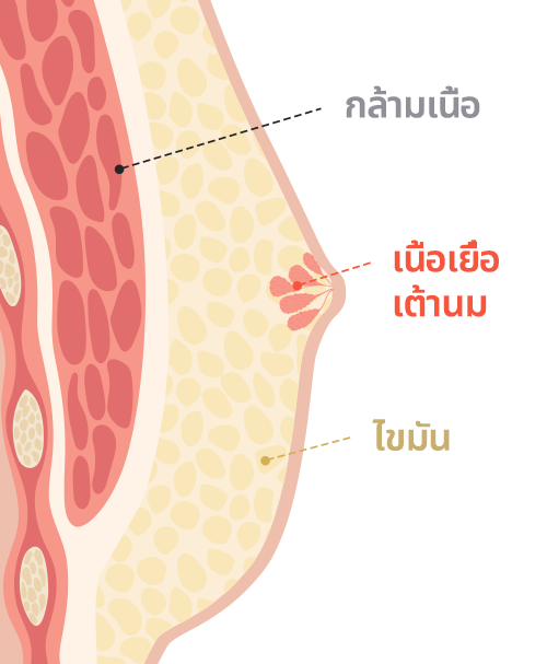 Gynecomastia surgery