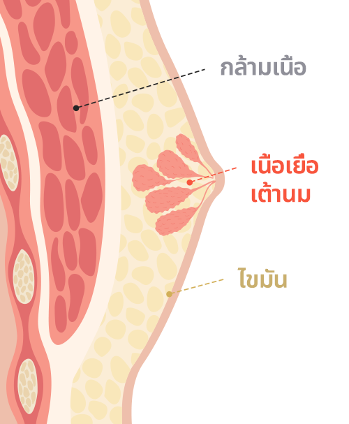 Gynecomastia surgery