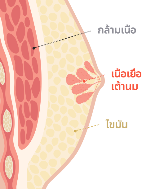 Gynecomastia surgery
