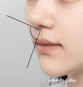 Harmonious side profile with balanced angles of the columella and philtrum