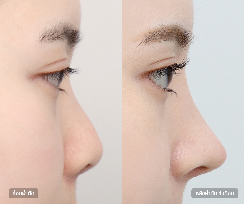 Short Nose Rhinoplasty