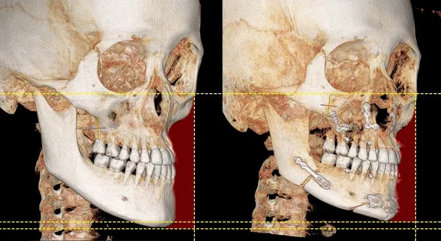 ภาพ 3D-CT ก่อนและหลังการผ่าตัดขากรรไกร