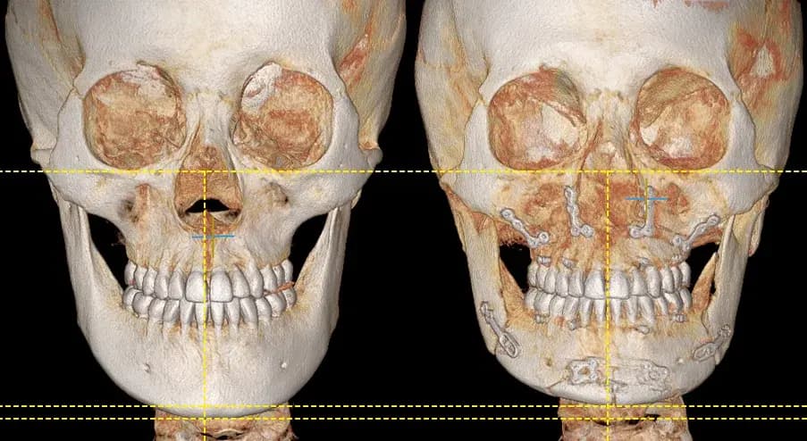 ภาพ 3D-CT ก่อนและหลังการผ่าตัดขากรรไกร
