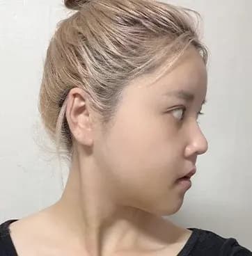หลังผ่าตัด 12 วัน