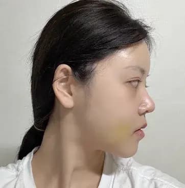 หลังผ่าตัด 14 วัน