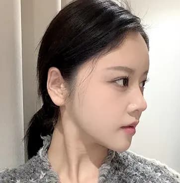 หลังผ่าตัด 3 เดือน