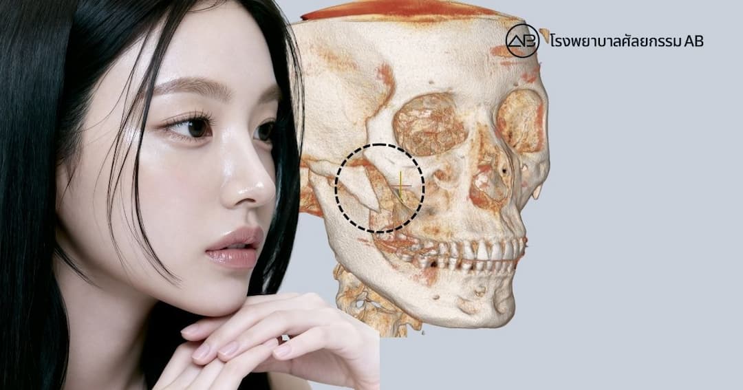 หลังผ่าตัดโครงหน้า ทำไมไม่มีหมุด? ต้องกังวลไหม? เช็กความปลอดภัยด้วย CT อย่างไร