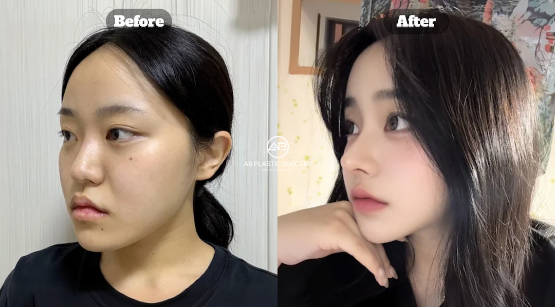 เสริมจมูกแบบโอเพ่น vs เสริมจมูกแบบโคลส ต่างกันอย่างไร และแบบไหนเหมาะกับคุณ?