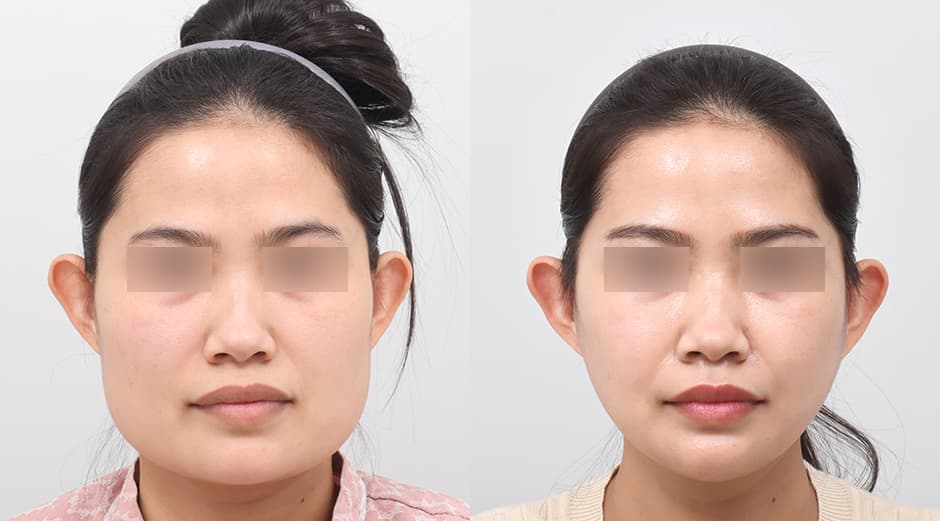 ศัลยกรรมโครงหน้า 2 จุด(กราม+โหนกแก้ม) before and after