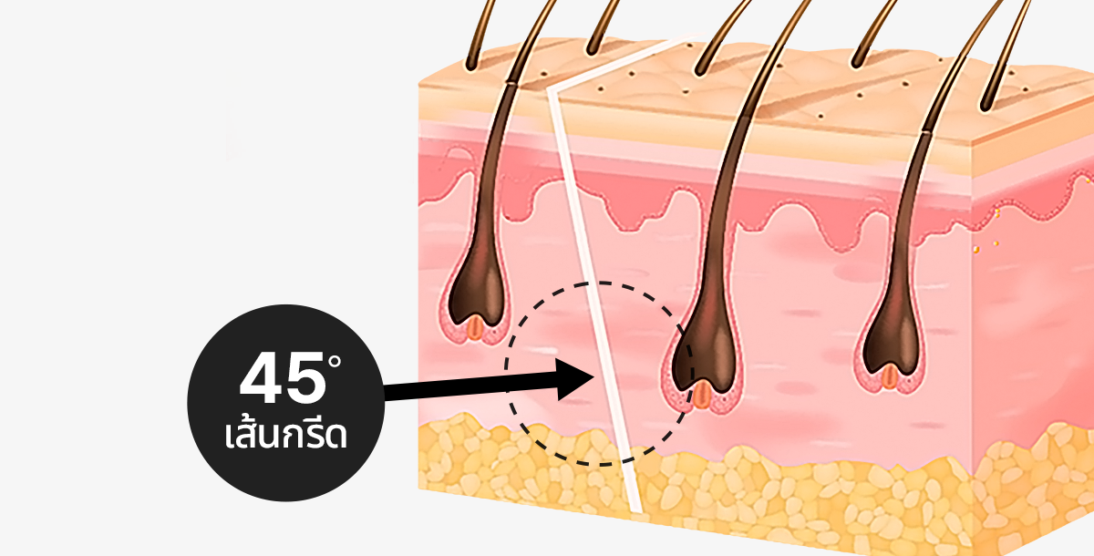 45-degree diagonal incision