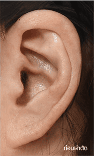 Skill matters in post-surgery scarring too. 1