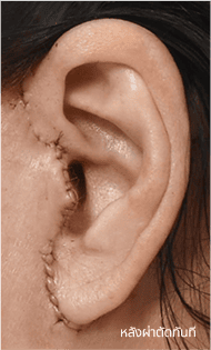 Skill matters in post-surgery scarring too. 2