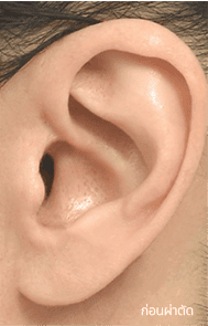 Skill matters in post-surgery scarring too. 1