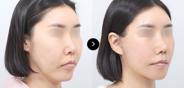 Semi Facelift 이미지 2