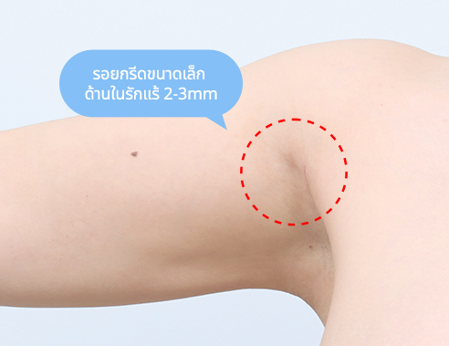 Minimal 2 to 3 mm incision on the inner armpit