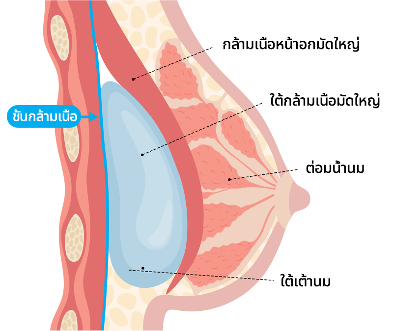 เสริมหน้าอกเทคนิค DUAL PLANE