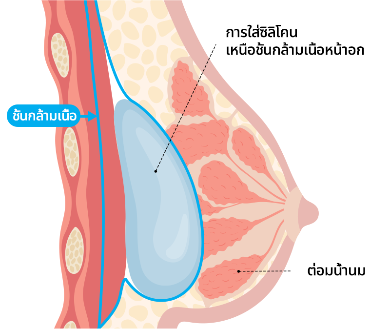 เสริมหน้าอกเหนือกล้ามเนื้อ