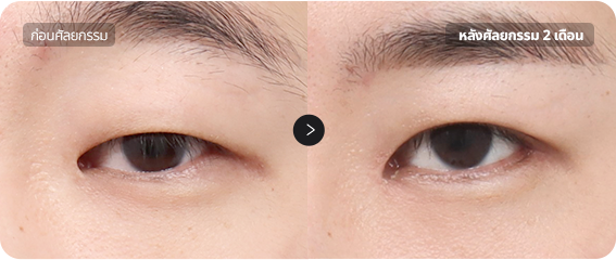 Before and After