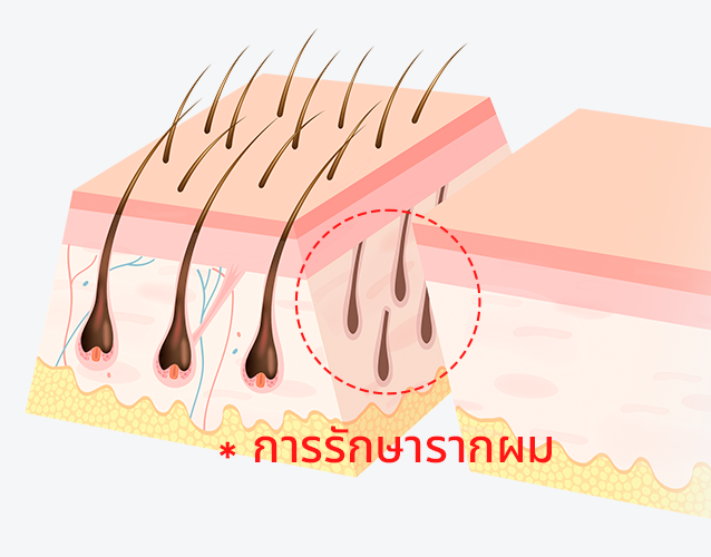 การกรีดเฉียง 45 องศา เพื่อรักษารากผมไว้