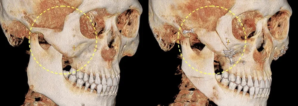 Facial contouring CT before and after 3